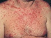 Diseases That Share the Same Symptoms as HIV/AIDS In The Early Stages