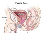 What Men Should Do To Reduce The Risk Of Prostate Enlargement As They Grow Older