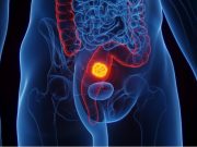 Alarming study shows bowel cancer killing more under-45s, with death rates continuing to rise