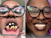 Woman Saw ‘No Signs’ of Dental Disease Then Lost Several Teeth. How Her Cosmetic Surgery Changed Her Life (Exclusive)