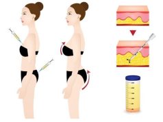 The Dark Side of BBL: How the Procedure Can Harm the Body