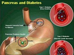 Diabetes kills. Stop excessive intake of these 4 substance if you want to enjoy your life