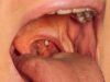If These Objects Come Out From Your Mouth After Coughing, This Is What It Means