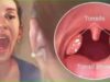 How To Cure Tonsillitis In 4 Hours, Fast And Easy.
