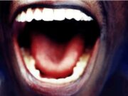 Here Are Mouth Signs Of HIV/AIDS
