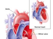 Heart Disease Kill Fast: Avoid Too Much Intake Of These 3 Things If You Want To Live Longer