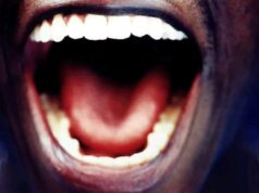 Here Are Mouth Signs Of HIV/AIDS