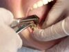 Quick Relief For Toothache: Home Remedies For Tooth Pain, Holes In Teeth