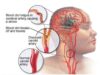 Days before a stroke attack, your body may give you these 7 signals