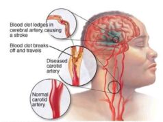 Days before a stroke attack, your body may give you these 7 signals