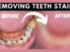 How To Remove Deep Brown Stains From Your Teeth With These Kitchen Ingredients