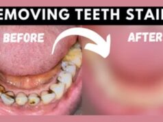 How To Remove Deep Brown Stains From Your Teeth With These Kitchen Ingredients