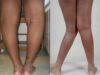 what Causes Knocked Knees or Legs To Bend Like These