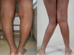 what Causes Knocked Knees or Legs To Bend Like These